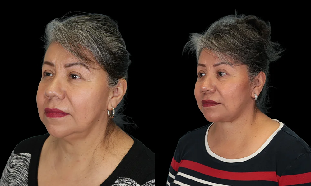 Real patient results in New York, NY Performed by Sameer Halani, MD