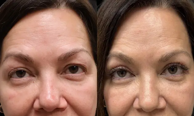 Real patient results in New York, NY Performed by Sameer Halani, MD