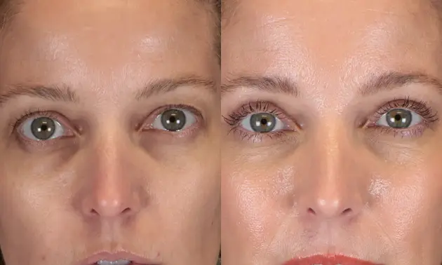Real patient results in New York, NY Performed by Sameer Halani, MD