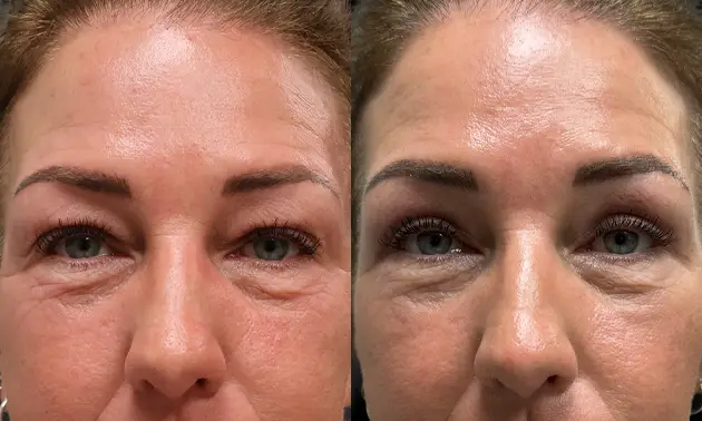 Real patient results in New York, NY Performed by Sameer Halani, MD