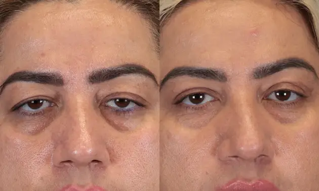 Real patient results in New York, NY Performed by Sameer Halani, MD