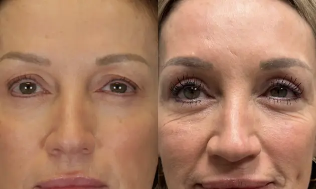 Real patient results in New York, NY Performed by Sameer Halani, MD