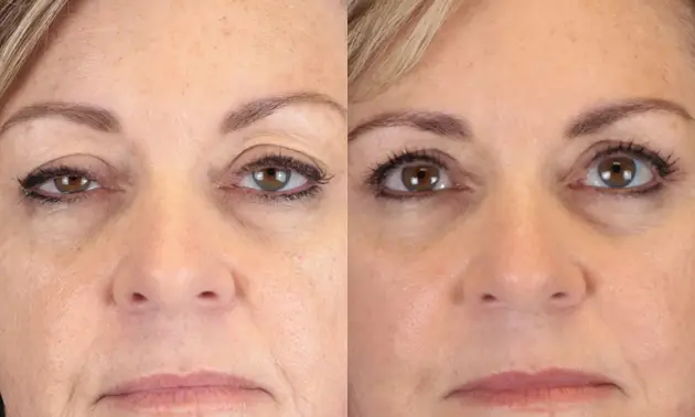Real patient results in New York, NY Performed by Sameer Halani, MD