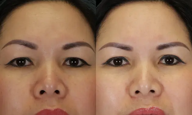 Real patient results in New York, NY Performed by Sameer Halani, MD