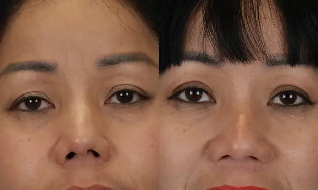 Real patient results in New York, NY Performed by Sameer Halani, MD