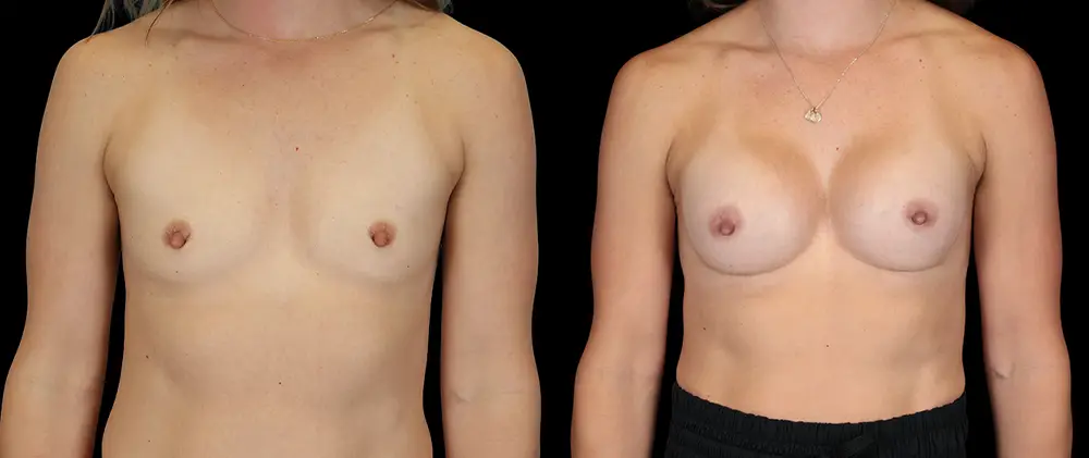 Real patient results in New York, NY Performed by Sameer Halani, MD