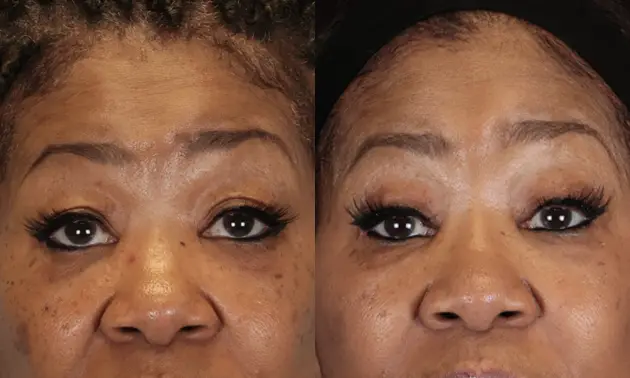 Real patient results in New York, NY Performed by Sameer Halani, MD