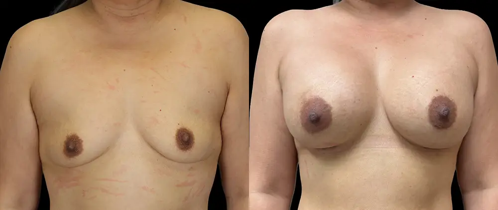 Real patient results in New York, NY Performed by Sameer Halani, MD