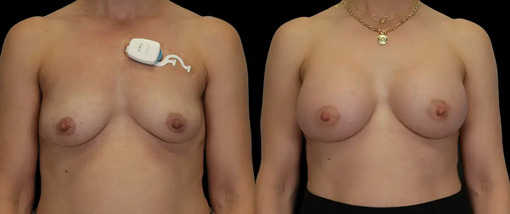 Real patient results in New York, NY Performed by Sameer Halani, MD