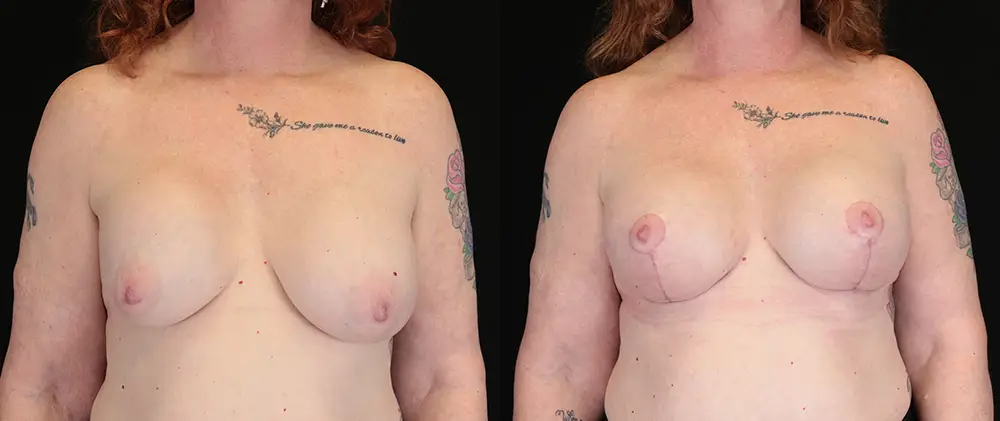 Real patient results in New York, NY Performed by Sameer Halani, MD