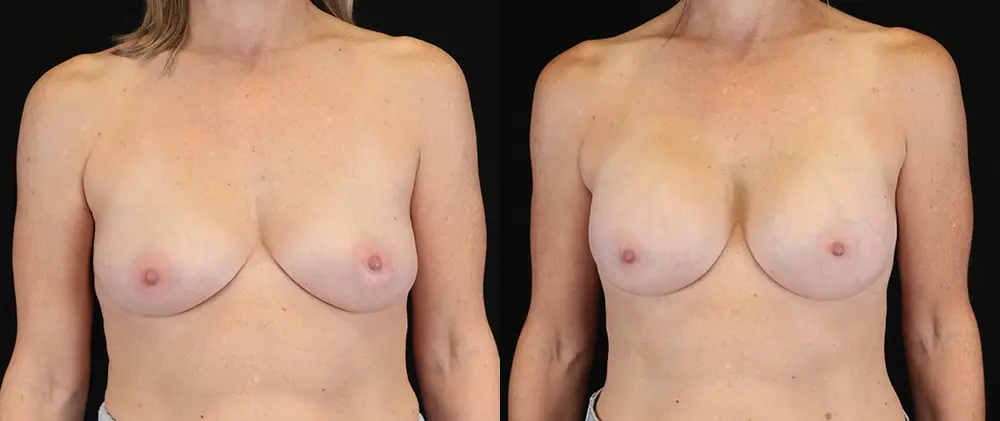Real patient results in New York, NY Performed by Sameer Halani, MD