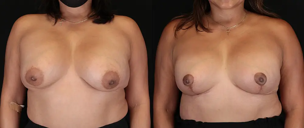 Real patient results in New York, NY Performed by Sameer Halani, MD