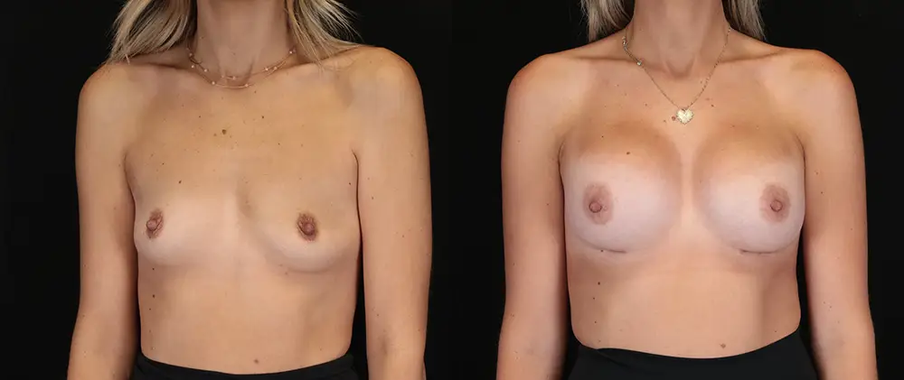 Real patient results in New York, NY Performed by Sameer Halani, MD