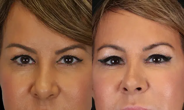 Real patient results in New York, NY Performed by Sameer Halani, MD