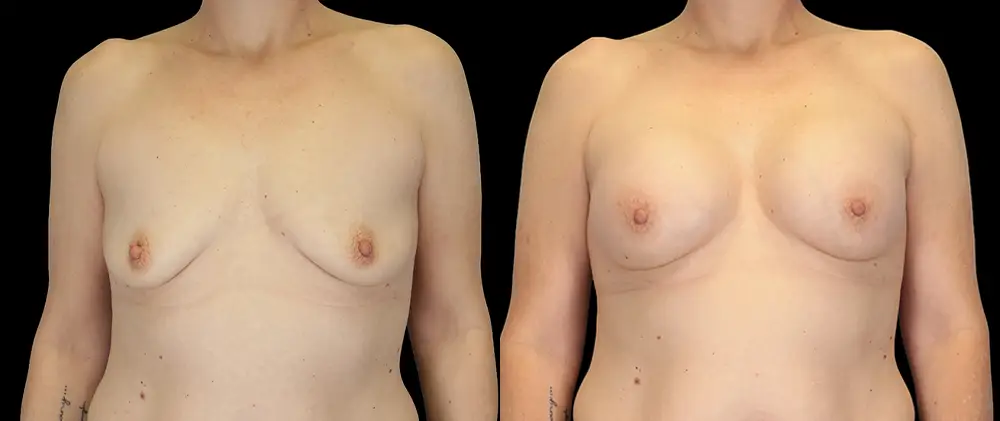 Real patient results in New York, NY Performed by Sameer Halani, MD