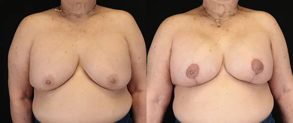 Real patient results in New York, NY Performed by Sameer Halani, MD