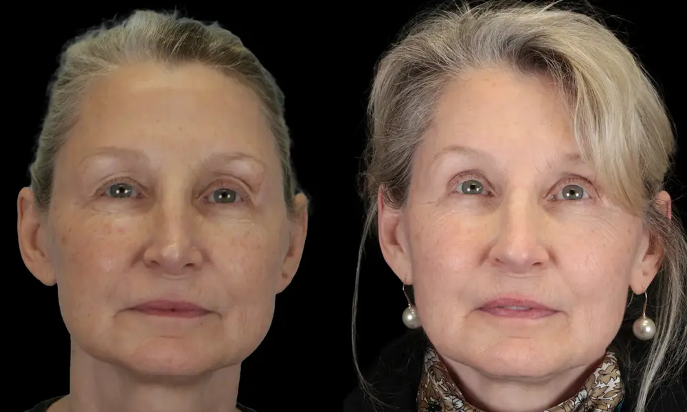 Real patient results in New York, NY Performed by Sameer Halani, MD
