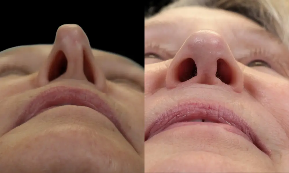 Real patient results in New York, NY Performed by Sameer Halani, MD