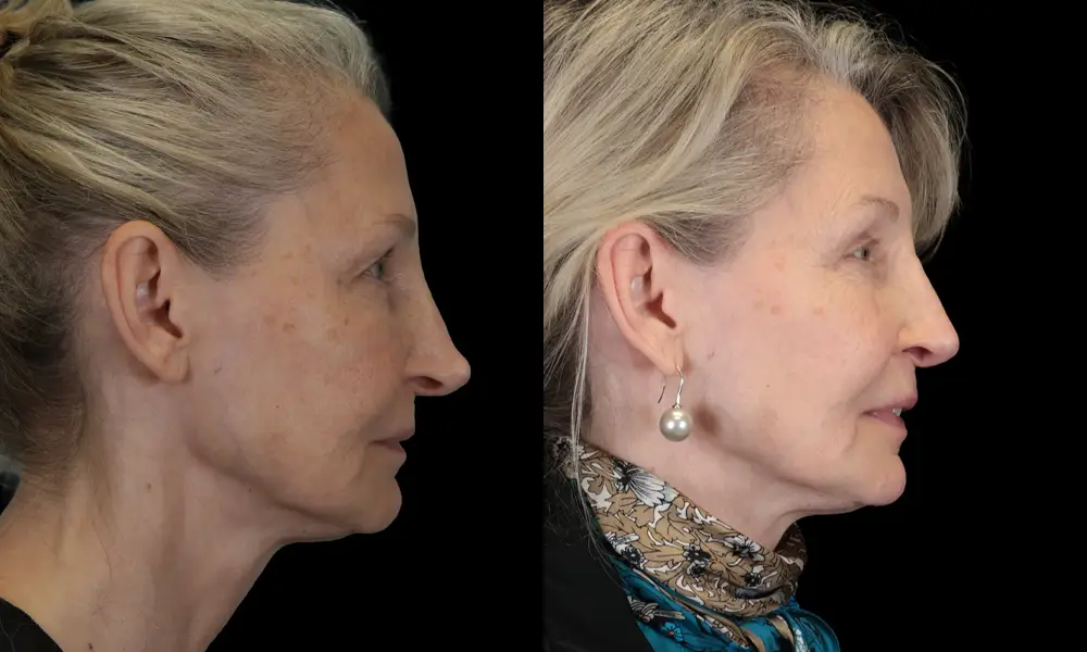 Real patient results in New York, NY Performed by Sameer Halani, MD