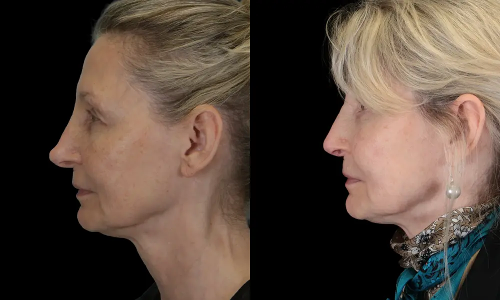 Real patient results in New York, NY Performed by Sameer Halani, MD