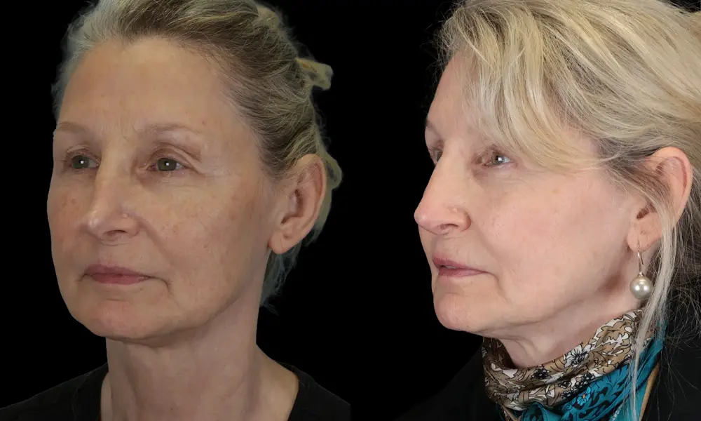 Real patient results in New York, NY Performed by Sameer Halani, MD
