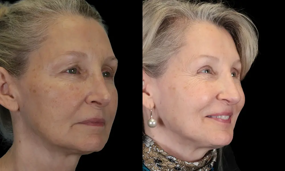 Real patient results in New York, NY Performed by Sameer Halani, MD