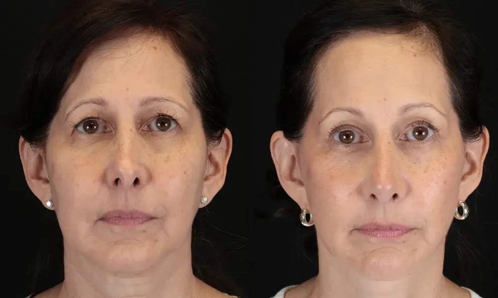 Real patient results in New York, NY Performed by Sameer Halani, MD