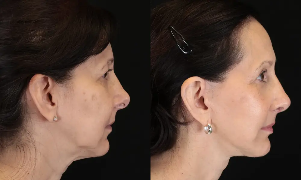 Real patient results in New York, NY Performed by Sameer Halani, MD