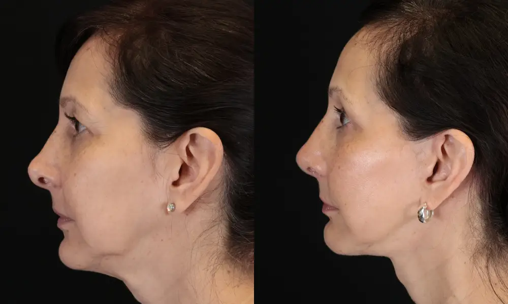 Real patient results in New York, NY Performed by Sameer Halani, MD