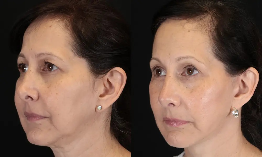 Real patient results in New York, NY Performed by Sameer Halani, MD