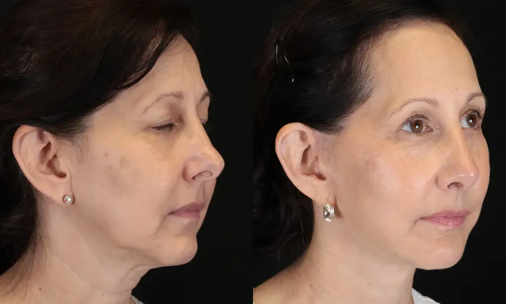 Real patient results in New York, NY Performed by Sameer Halani, MD