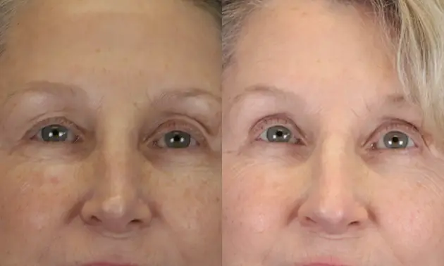 Real patient results in New York, NY Performed by Sameer Halani, MD