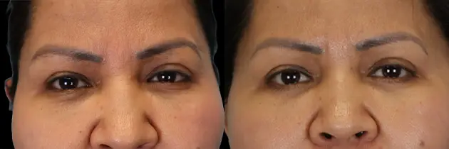 Real patient results in New York, NY Performed by Sameer Halani, MD
