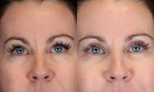 Real patient results in New York, NY Performed by Sameer Halani, MD