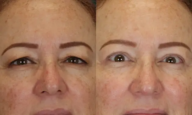 Real patient results in New York, NY Performed by Sameer Halani, MD