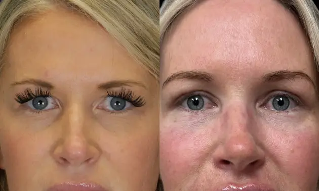 Real patient results in New York, NY Performed by Sameer Halani, MD