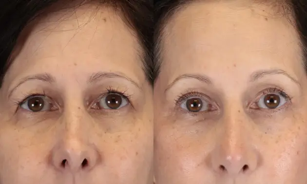 Real patient results in New York, NY Performed by Sameer Halani, MD