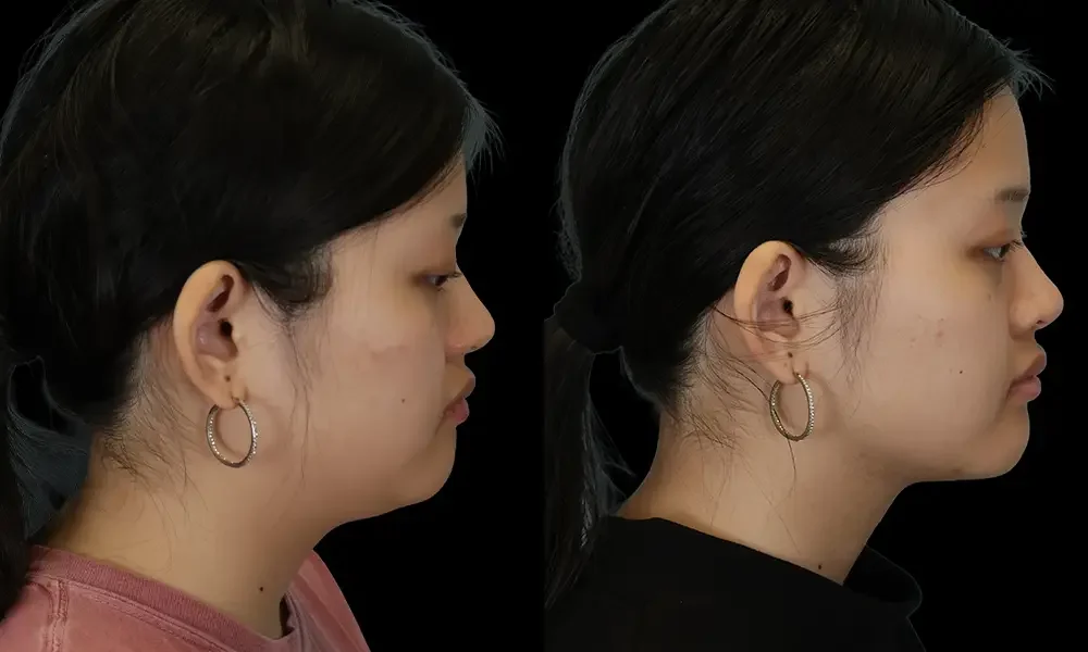 Real patient results in New York, NY Performed by Sameer Halani, MD