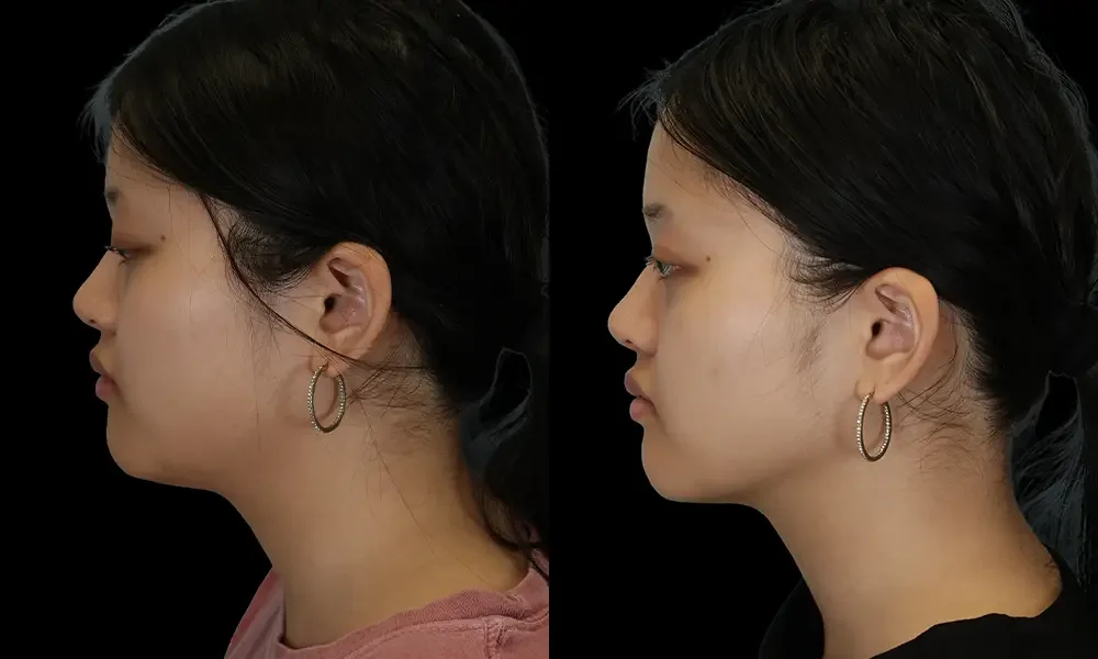 Real patient results in New York, NY Performed by Sameer Halani, MD