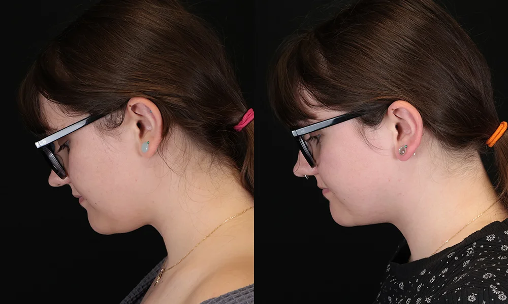 Real patient results in New York, NY Performed by Sameer Halani, MD