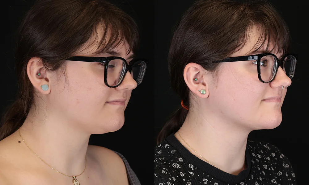 Real patient results in New York, NY Performed by Sameer Halani, MD