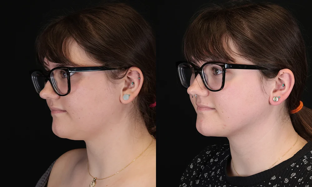 Real patient results in New York, NY Performed by Sameer Halani, MD
