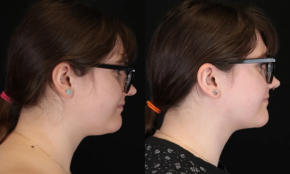 Real patient results in New York, NY Performed by Sameer Halani, MD
