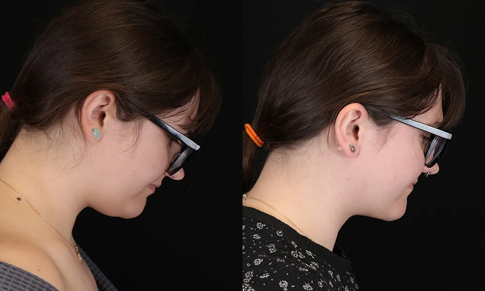 Real patient results in New York, NY Performed by Sameer Halani, MD