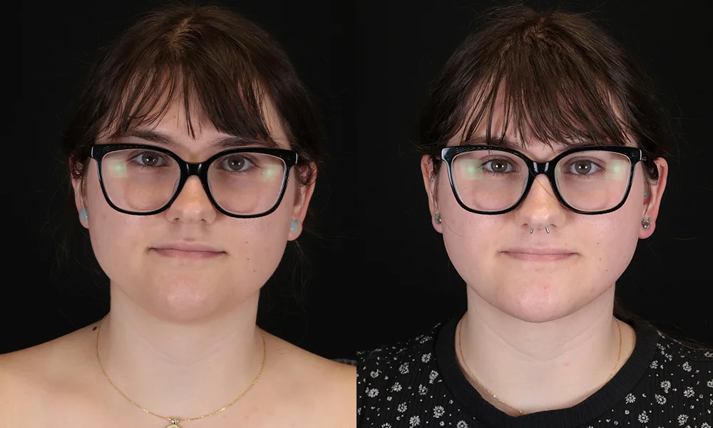 Real patient results in New York, NY Performed by Sameer Halani, MD