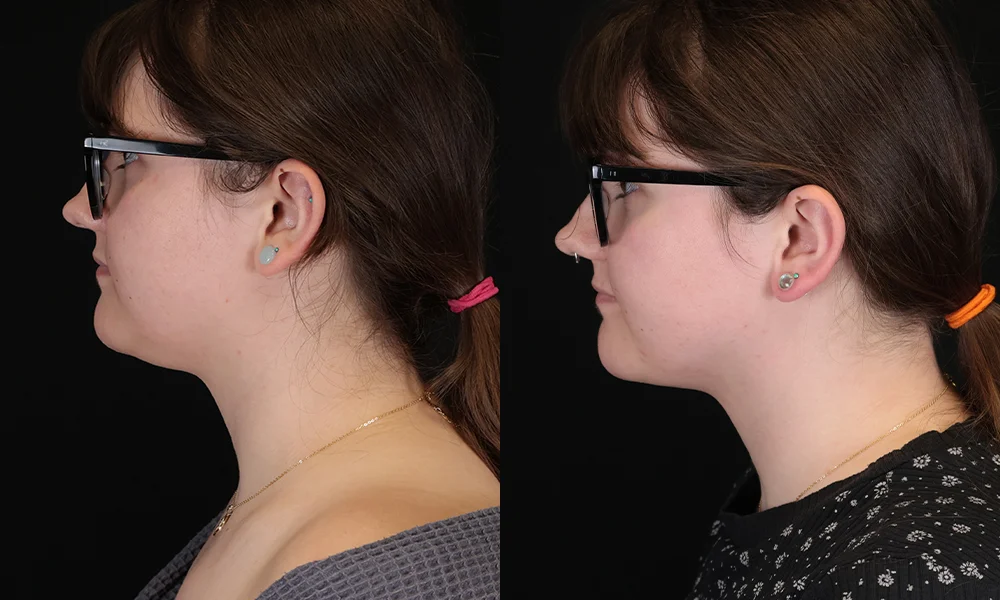 Real patient results in New York, NY Performed by Sameer Halani, MD
