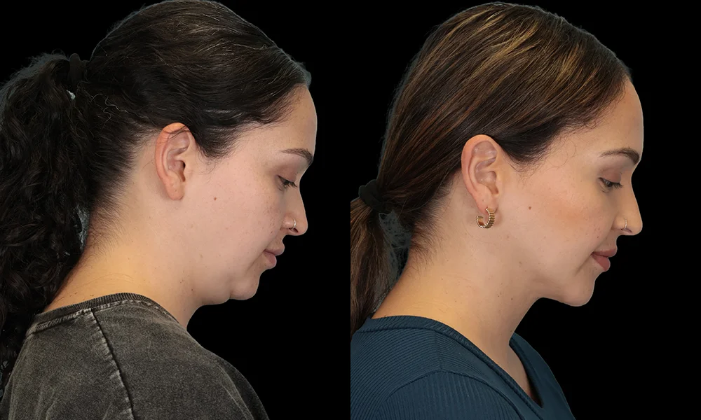 Real patient results in New York, NY Performed by Sameer Halani, MD