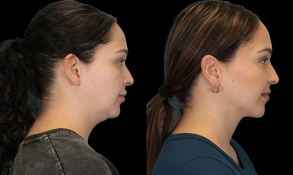 Real patient results in New York, NY Performed by Sameer Halani, MD