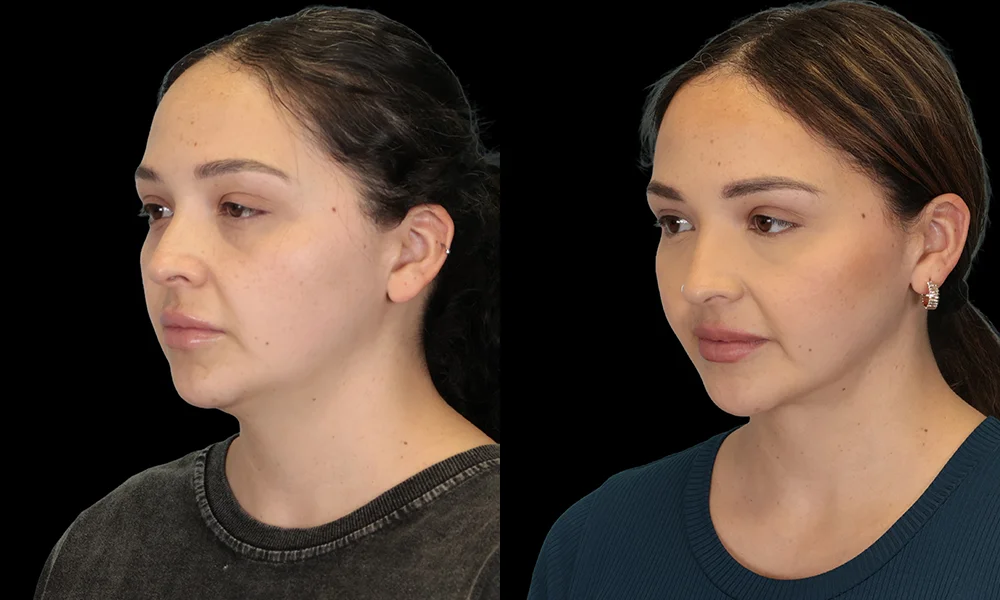 Real patient results in New York, NY Performed by Sameer Halani, MD