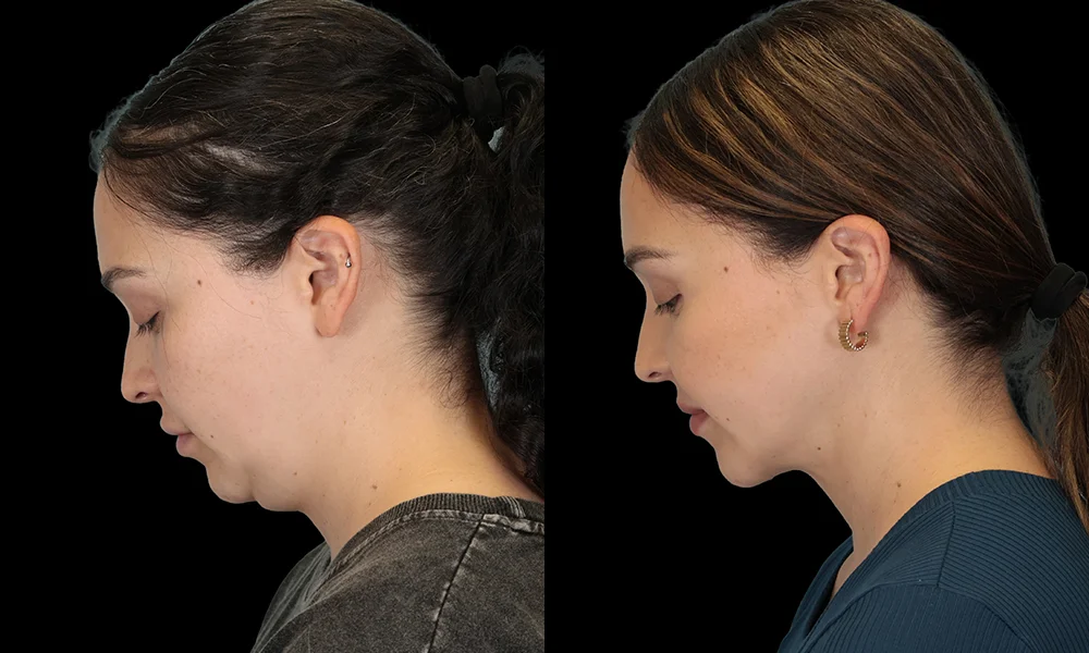 Real patient results in New York, NY Performed by Sameer Halani, MD